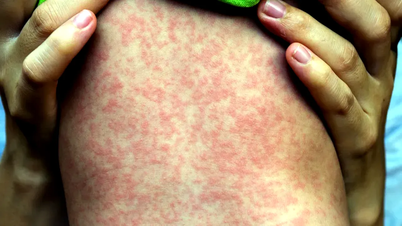 5 boli CUMPLITE din istoria omenirii care se întorc, deși fuseseră eradicate