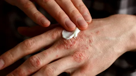 Boala declanșată de stres și care nu se vindecă! Mulți tineri se confruntă cu ea și au probleme de socializare