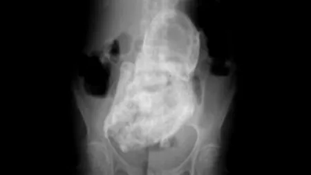 Ce a descoperit o femeie de 84 de ani, când a mers la spital cu dureri de stomac