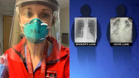 Plămânii unui pacient COVID-19, mai deteriorați decât ai „oricărui fumător”. Chirurg: 70-80% din cazurile asimptomatice au avut leziuni la plămâni - FOTO