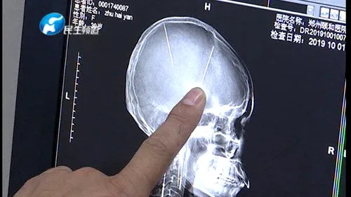 Descoperire șocantă: O femeie și-a făcut o tomografie, iar rezultatele i-au lăsat pe medici fără cuvinte! - FOTO