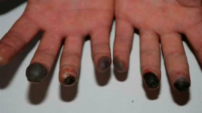 Caz unic în Germania: o femeie a suferit degerături în plină vară