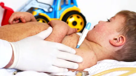 Rujeola UCIDE tot mai mulți români! Medicii se tem de ce este mai rău