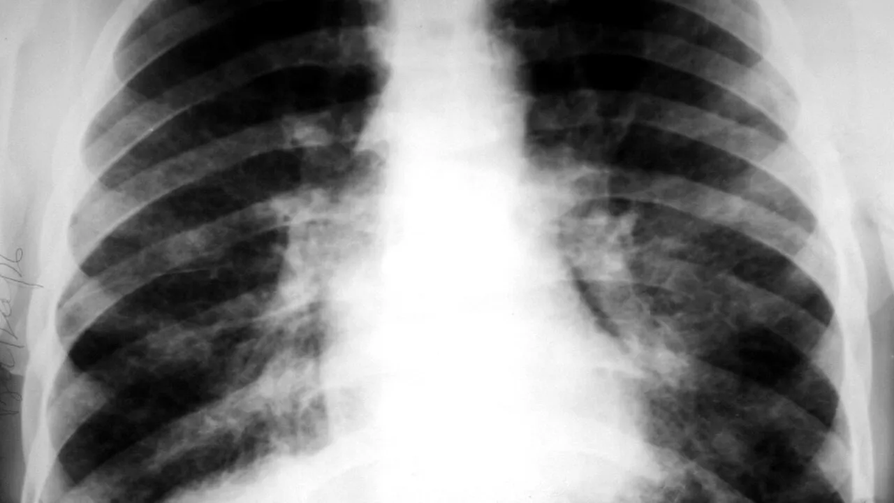 Neoplasm pulmonar, boala anului 2023. Avertismentul medicilor: nu doare, dar este fatală! Semnele care trebuie să te îngrijoreze