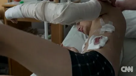 Armata rusă folosește bombe cu fragmentație în Ucraina. Medicii sunt șocați de rănile pe care trebuie să le îngrijească