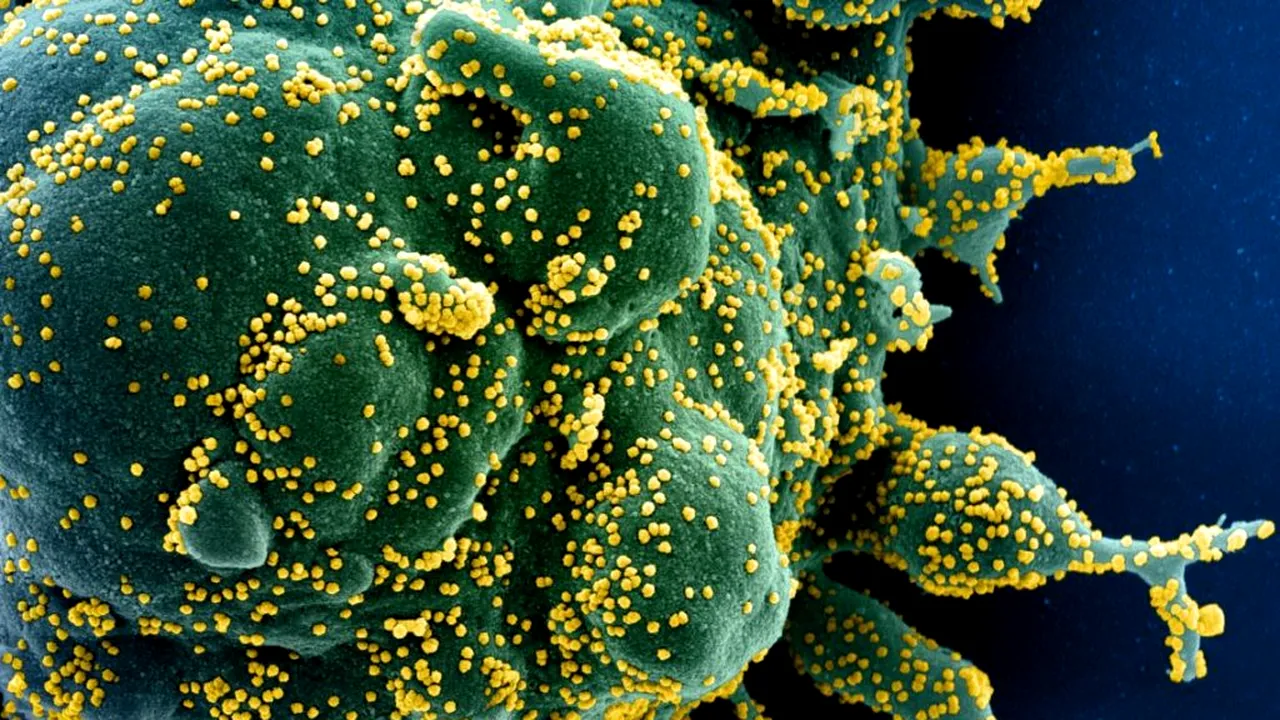 STUDIU: COVID-19 pompează acid hialuronic în plămâni. Motivul pentru care eșuează plămânii pacienților: „Alveolele devin gelatinoase, plămânul e ca un balon cu apă”