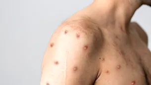 Încă două noi cazuri de variola maimuței, confirmate în România. Numărul îmbolnăvirilor a ajuns la 11