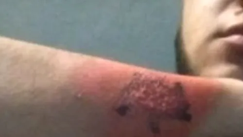 Și-a îndepărtatul tatuajul făcut cu o săptămână în urmă cu o răzătoare. Care este motivul din spatele gestului exagerat - FOTO / VIDEO 