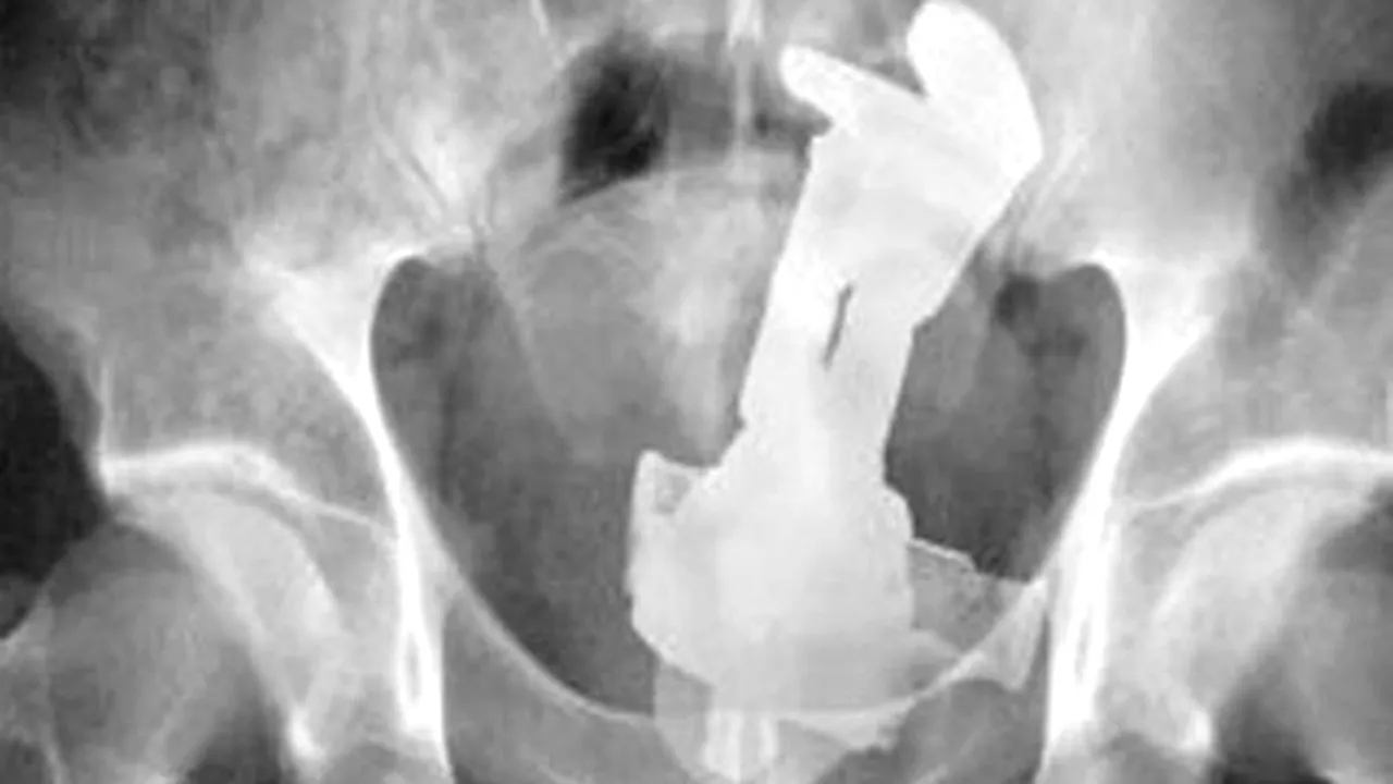 GALERIE FOTO: Cele mai terifiante radiografii