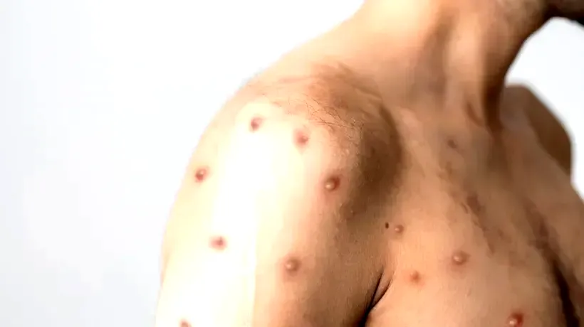 Şase persoane au fost vaccinate în România împotriva variolei maimuţei