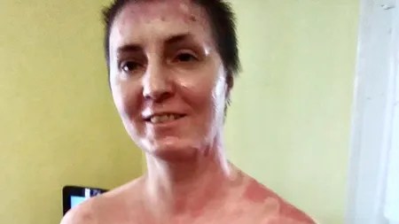 Mihaela a avut parte de două mari ghinioane în viață: primul, că a fost victima unui explozii, al doilea - că e din România. Acum are nevoie de un gest de generozitate